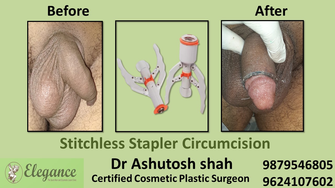 Stapler Circumcision Surgery in Bharuch