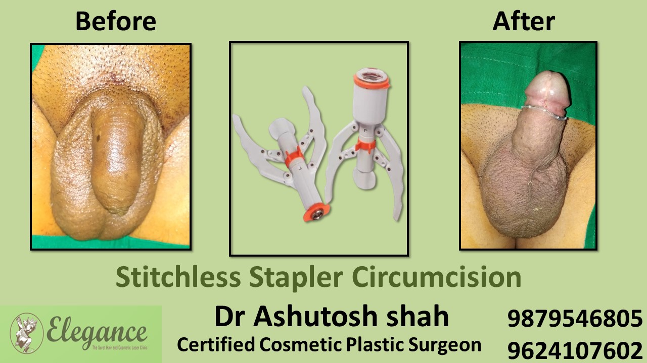 Stapler Circumcision Surgery in Vapi, Gujarat