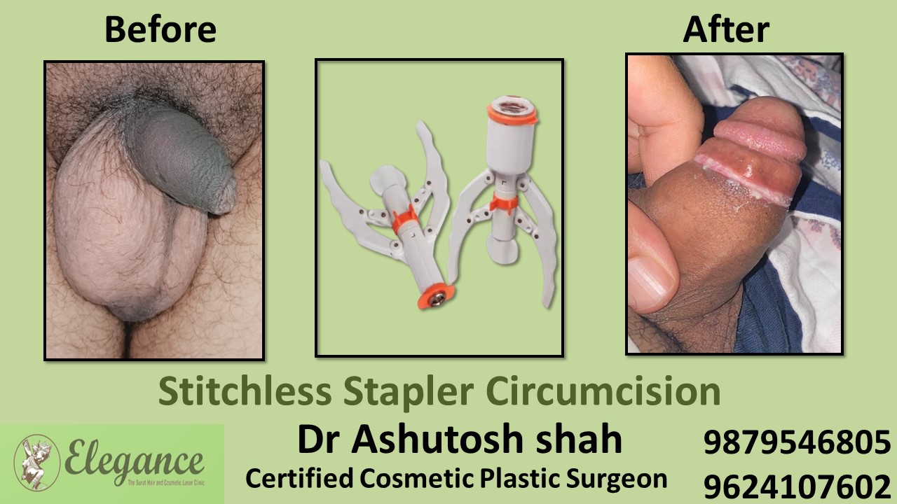 Stapler Circumcision Surgery in Daman