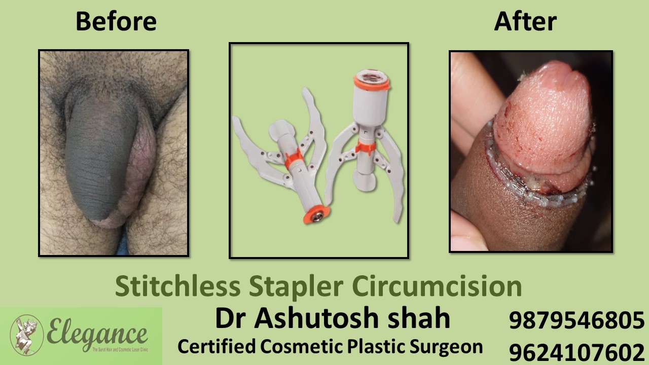 Stapler Circumcision Surgery in Goa