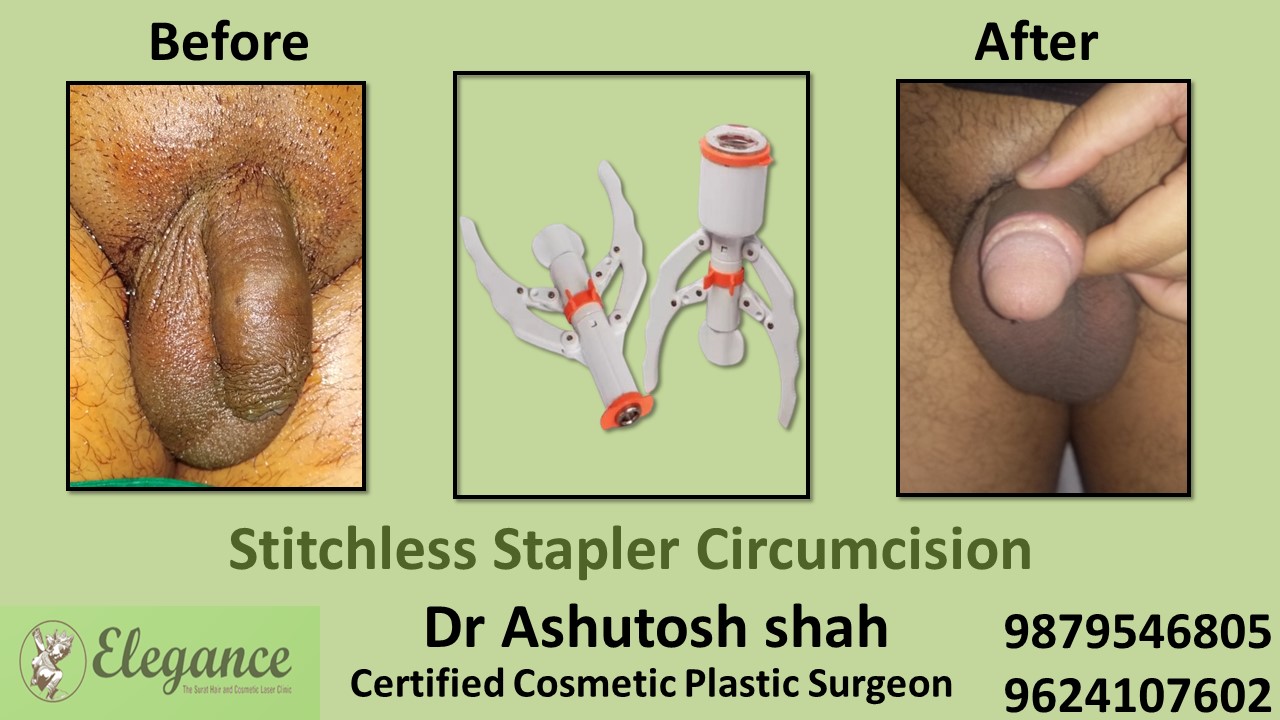 Stapler Circumcision Surgery in kim, Surat, Gujarat