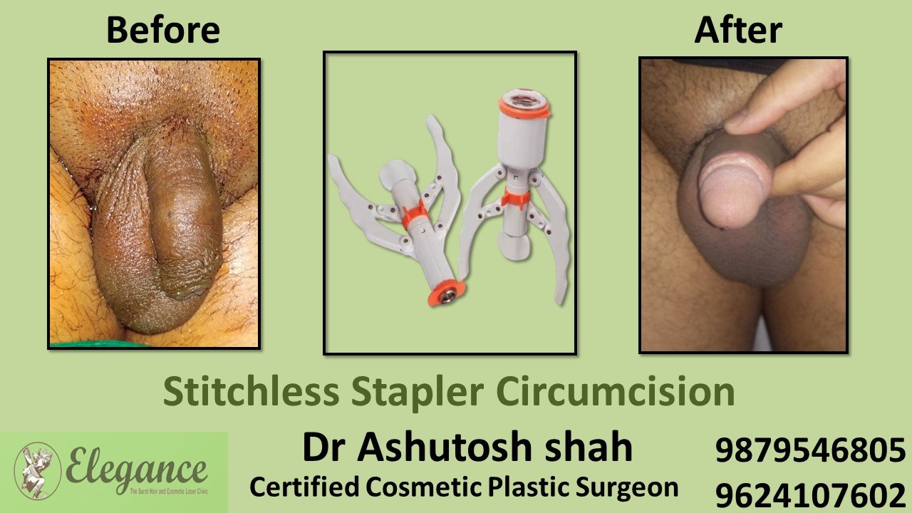 Stapler Circumcision Surgery in kim, Surat, Gujarat