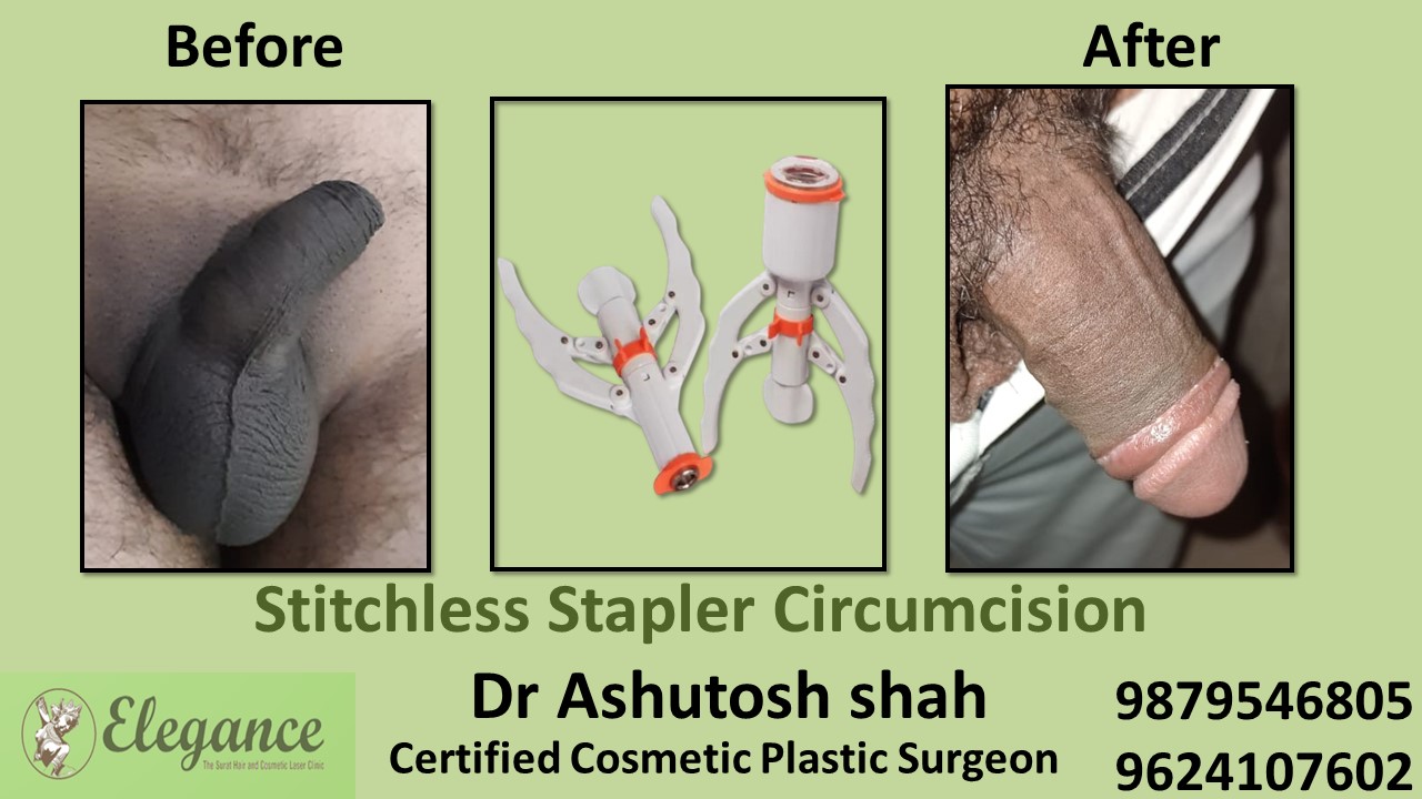 Stapler Circumcision Surgery in kosamba