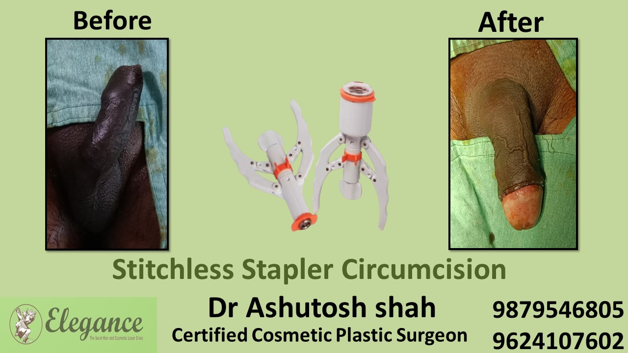Stapler Circumcision Surgery in Mangrol, Gujarat