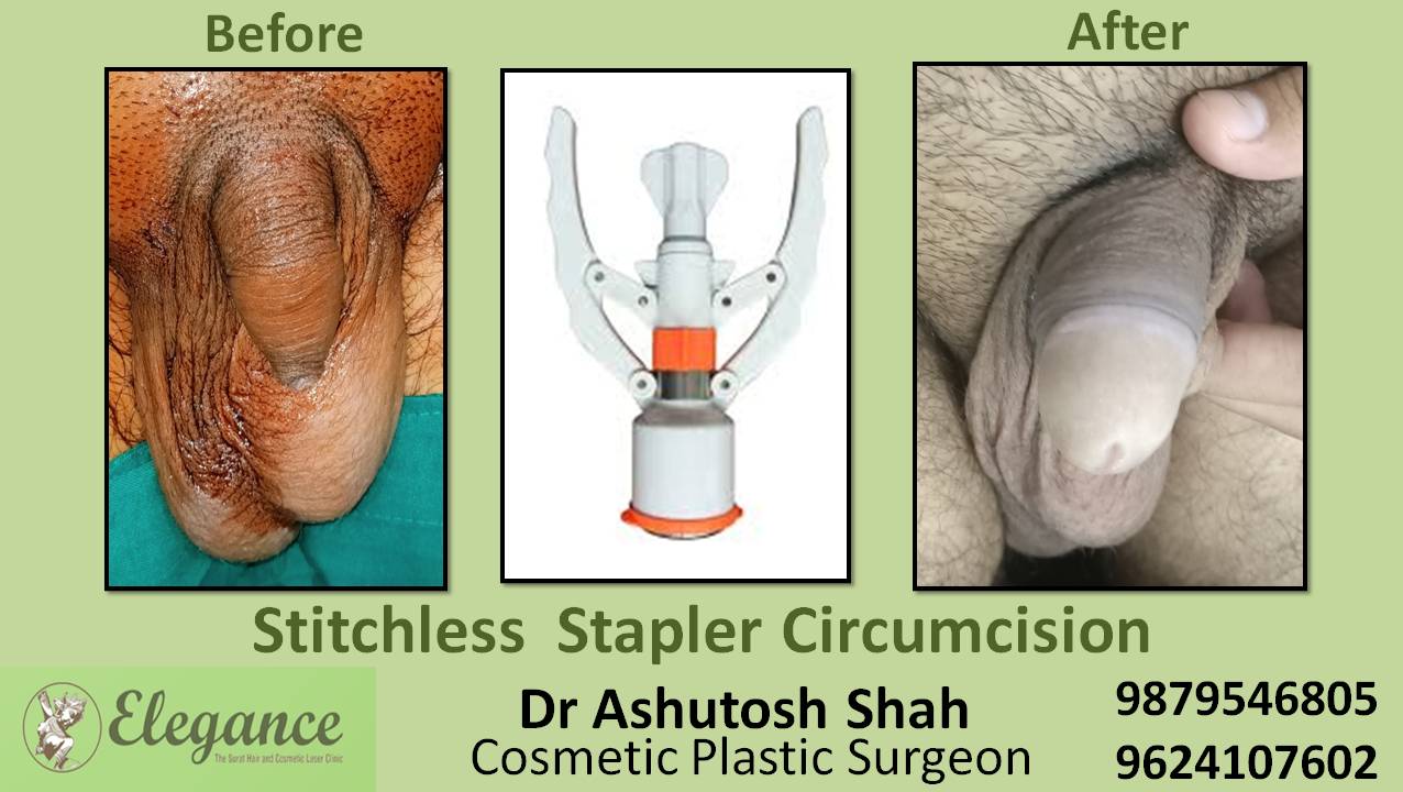 Stapler Circumcision Surgery, Kosamba, Gujarat, India