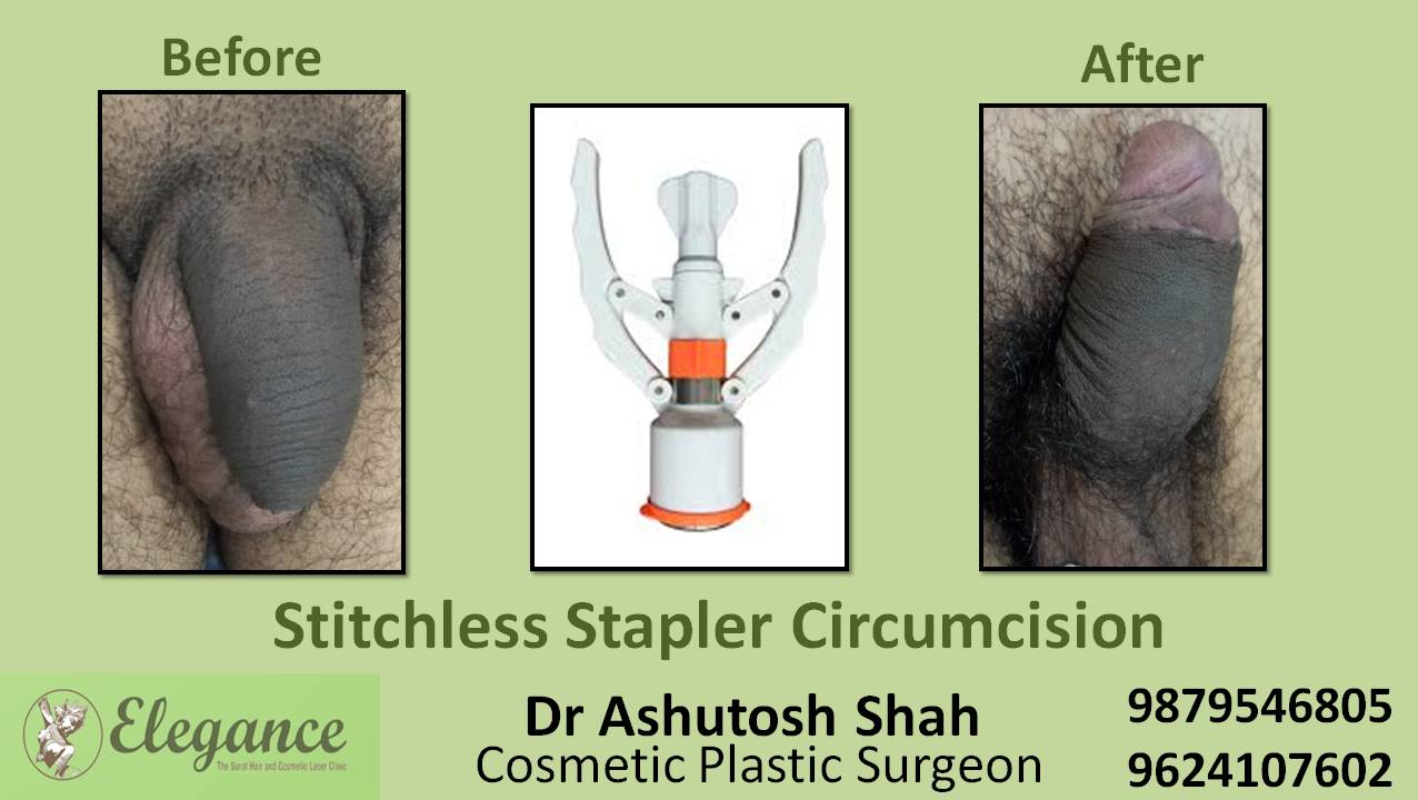 Stapler Circumcision Surgery, Kosamba, Gujarat.