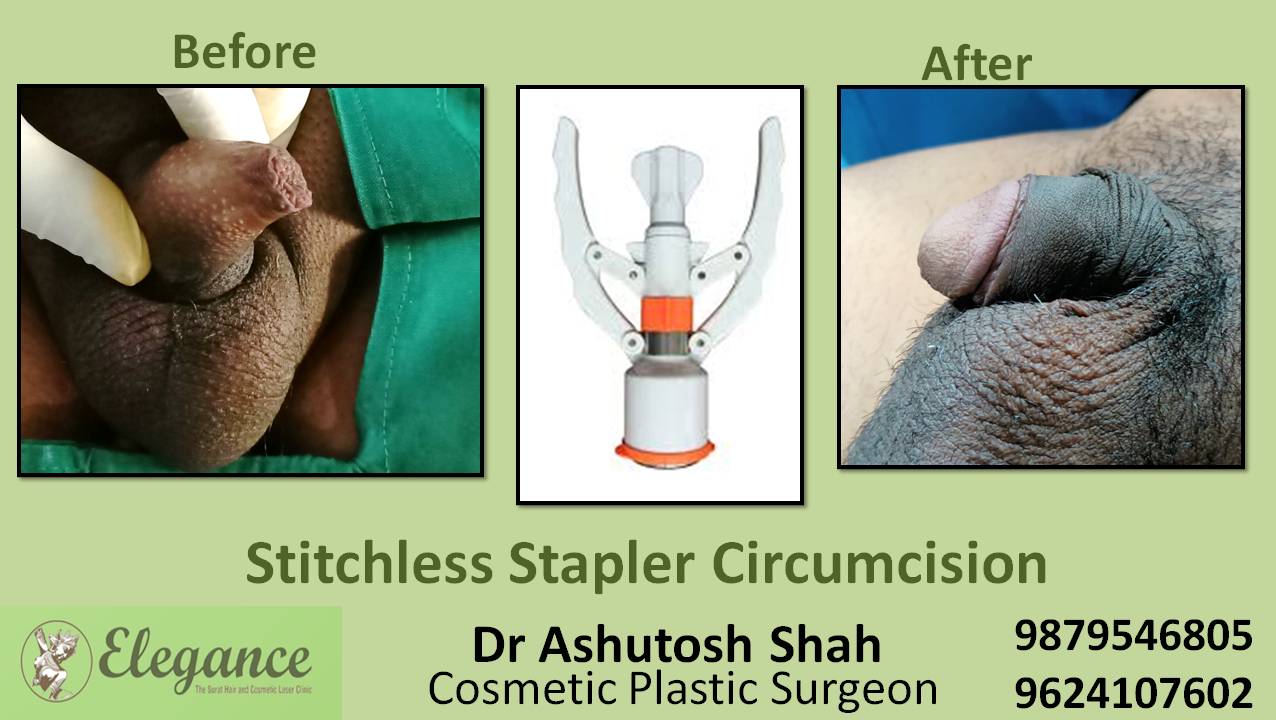 Stapler Circumcision Surgery, Mangrol, Gujarat, India