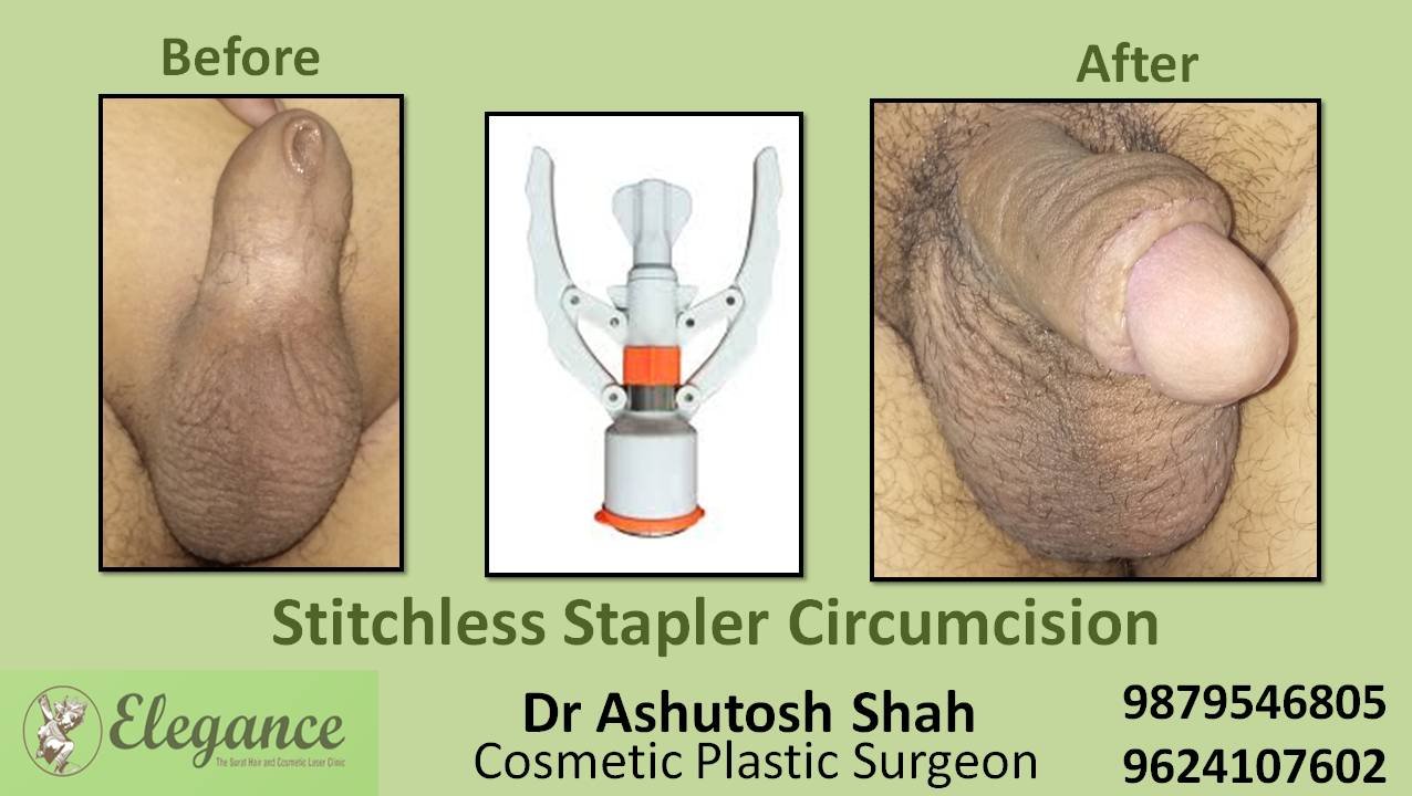 Stapler Circumcision Surgery, Mangrol, Gujarat.