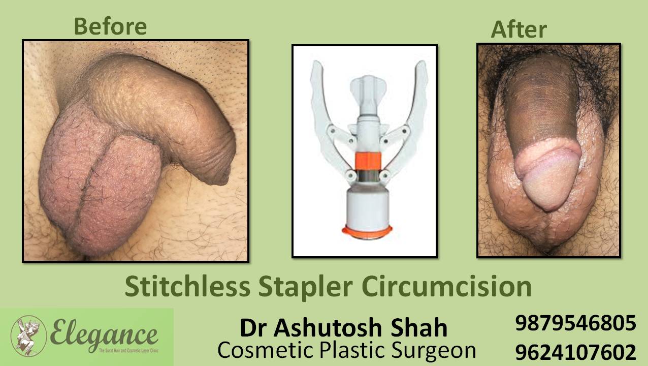 Stapler Circumcision Surgery, Navsari, Gujarat