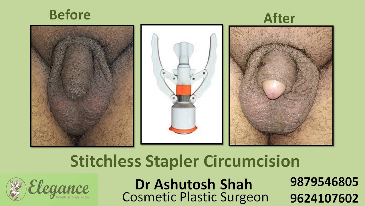 Stapler Circumcision Surgery, Navsari, Gujarat, India