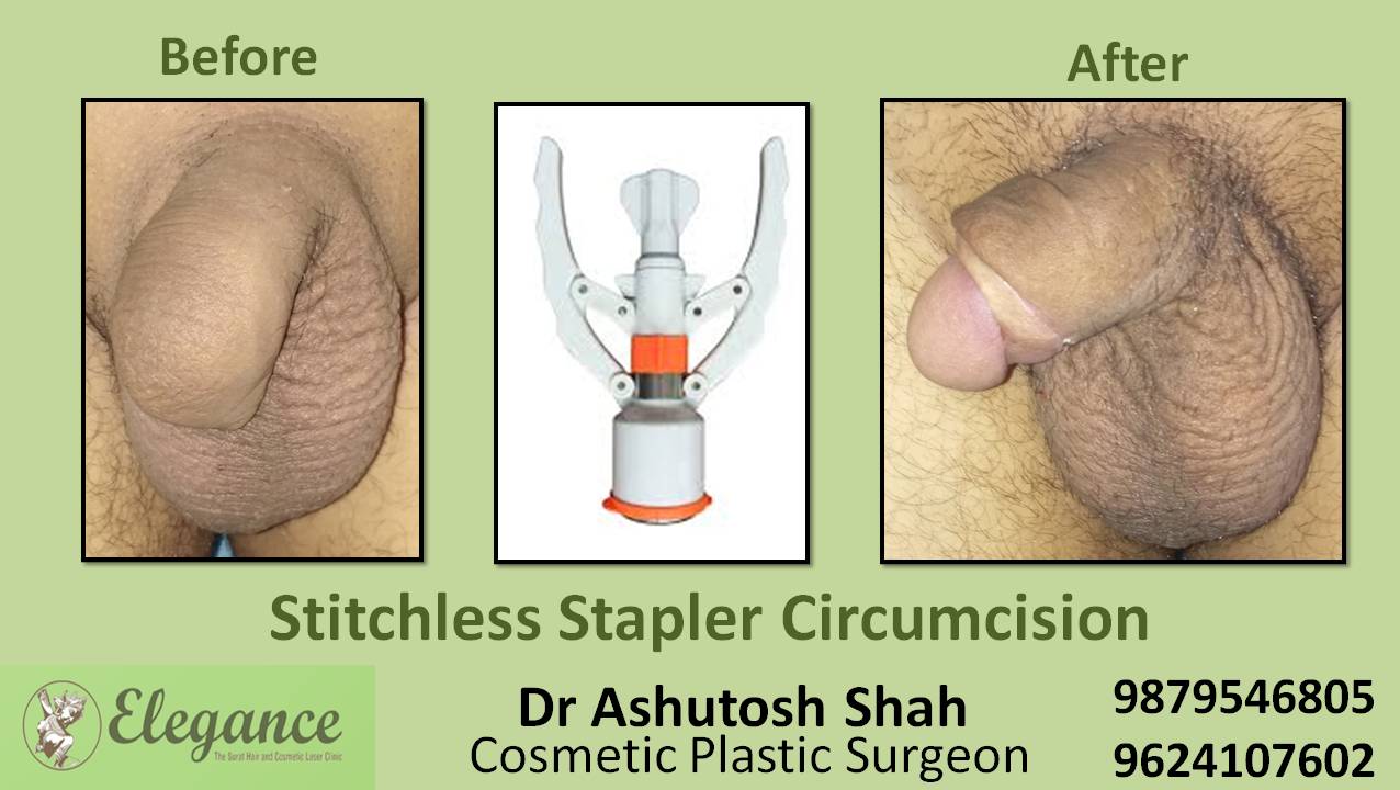 Stapler Circumcision Surgery, Selvasa, Gujarat, India