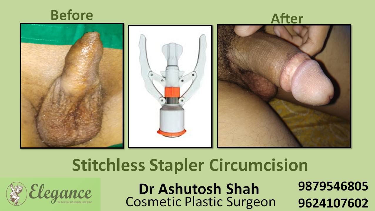 Stapler Circumcision Surgery, Surat, Gujarat, India