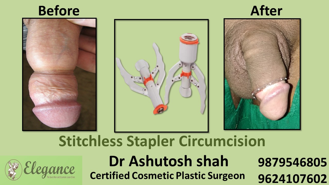 Stapler Circumcision Surgery Treatment in Adajan, Surat