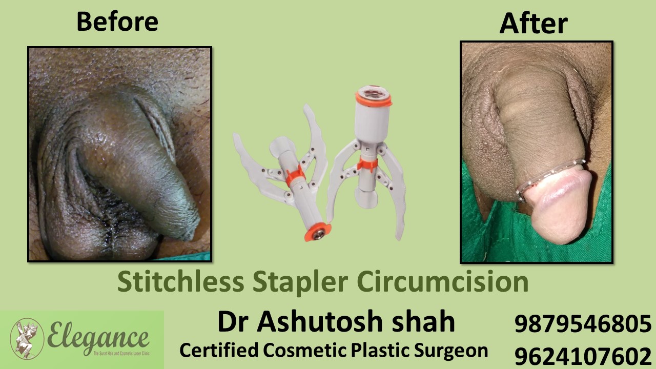 Stapler Circumcision Surgery Treatment in Sivassaa