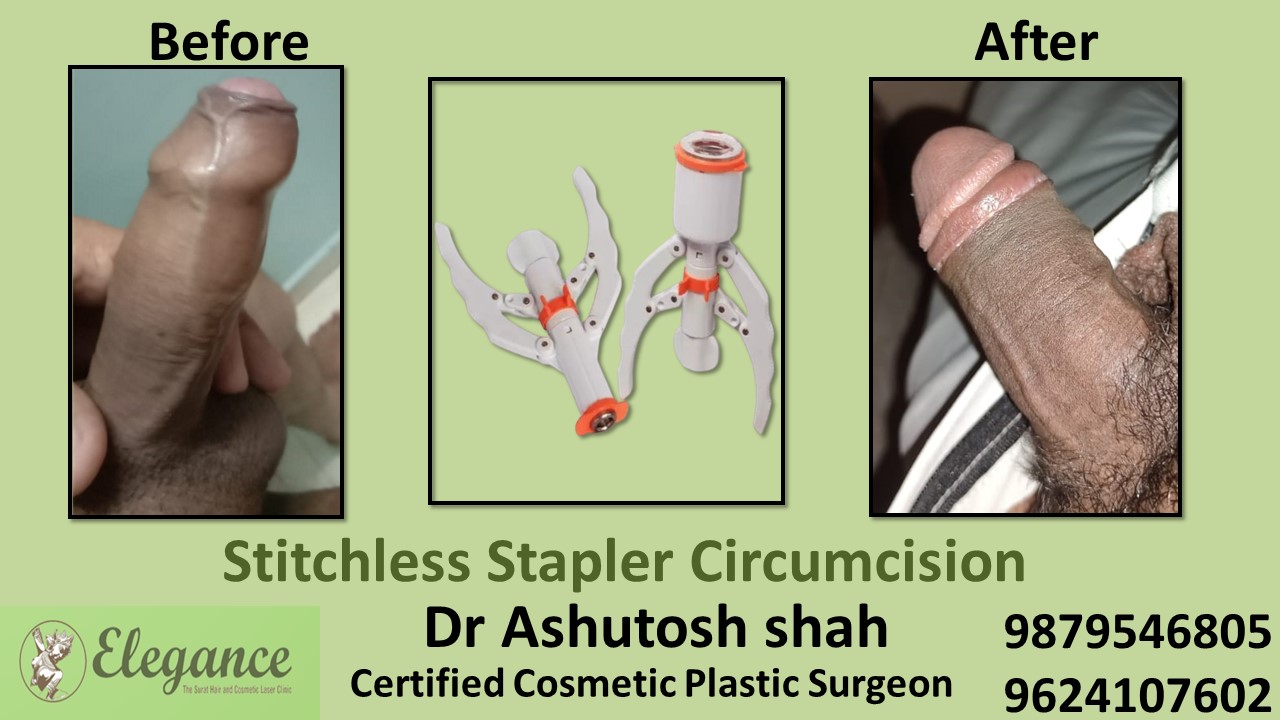 Stapler Circumcision Surgery Treatment in Vesu, Surat