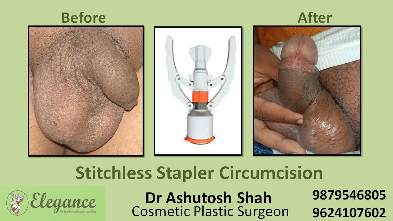 Stapler Circumcision Surgery, Vadodara, Gujarat.