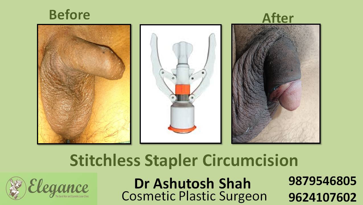 Stapler Circumcision Surgery, Valsad, Gujarat, India