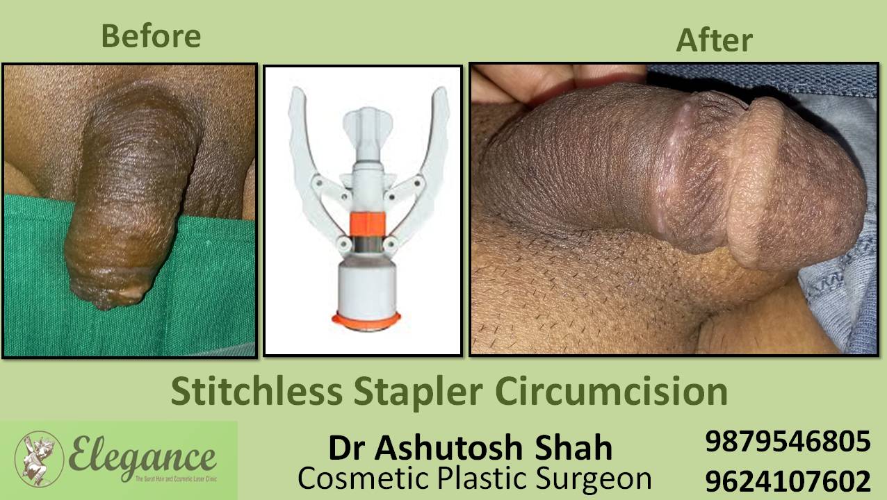 Stapler Circumcision Surgery, Valsad, Gujarat.