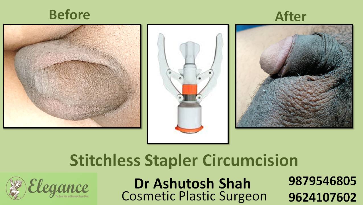 Stapler Circumcision Surgery, Vapi, Gujarat, India
