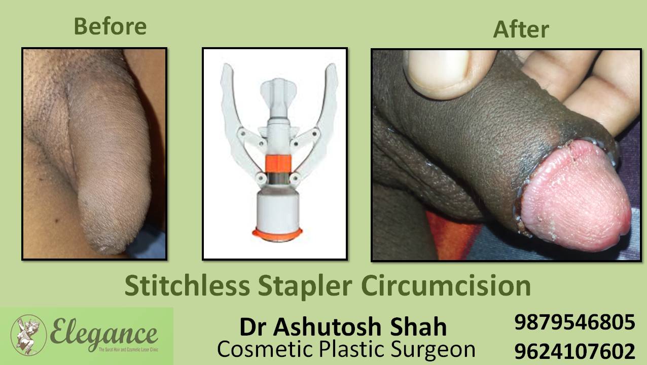 Stapler Circumcision Surgery, Vapi, Gujarat.