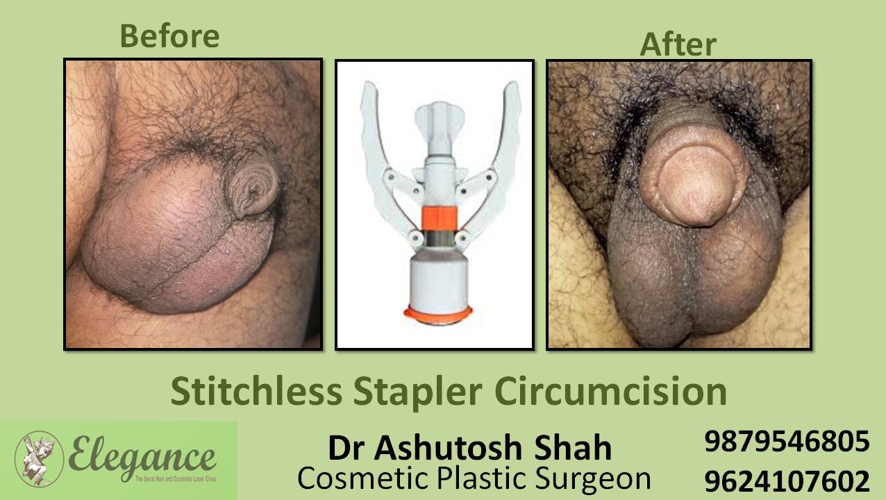 Stapler Circumcision Surgery, Baroda, Gujarat, India