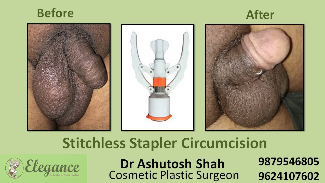 Stapler Circumcision Treatment, Ankleshwar, Gujarat, India.