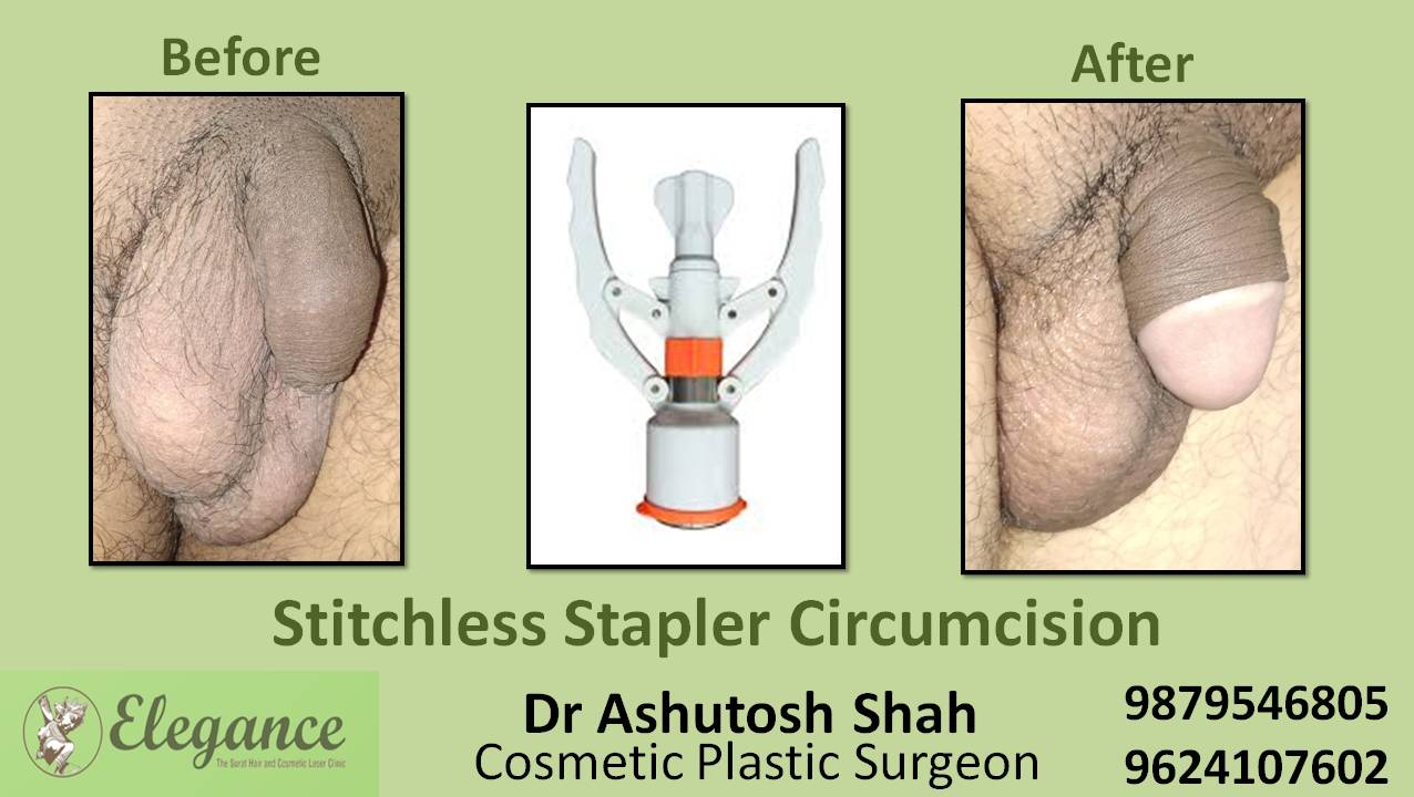 Stapler Circumcision Treatment, Bharuch, Gujarat, India.