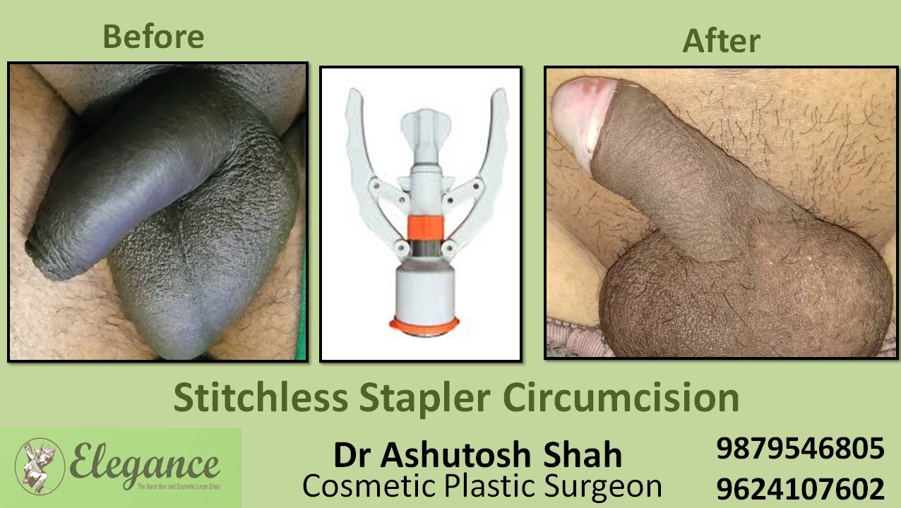 Stapler Circumcision Treatment, Bilimora, Gujarat, India.