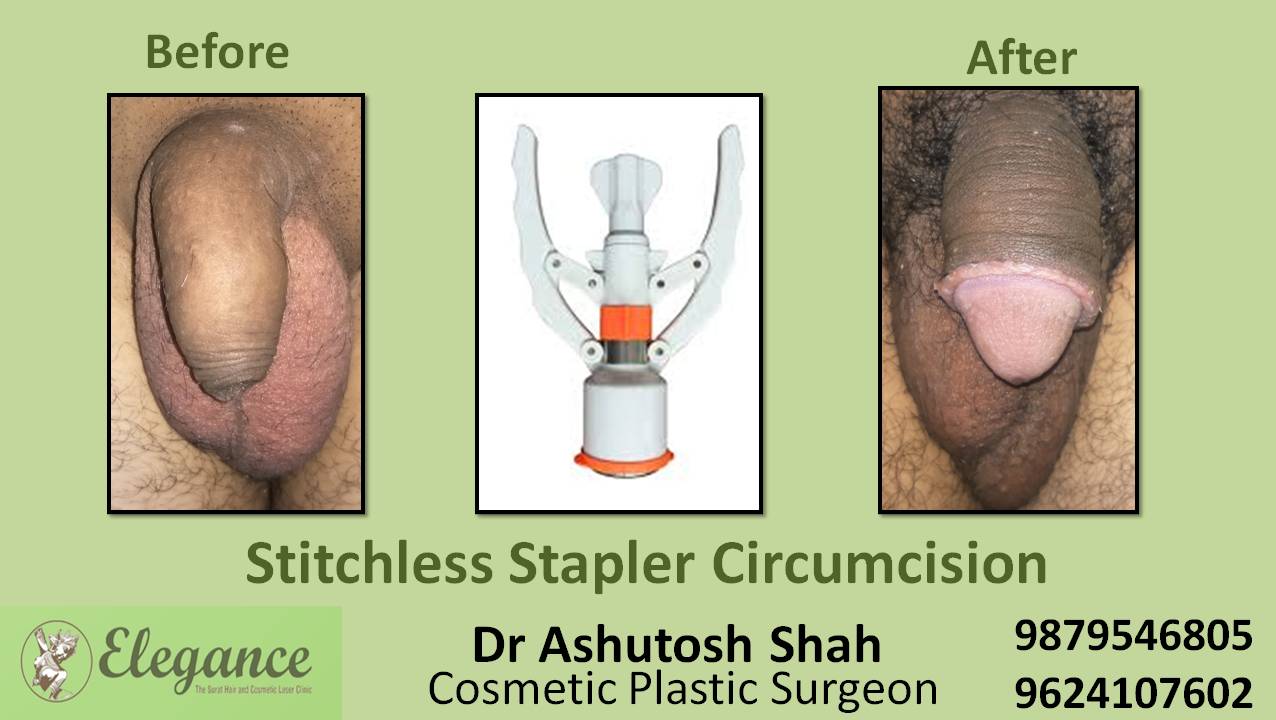 Stapler Circumcision Treatment, Daman, Gujarat, India.