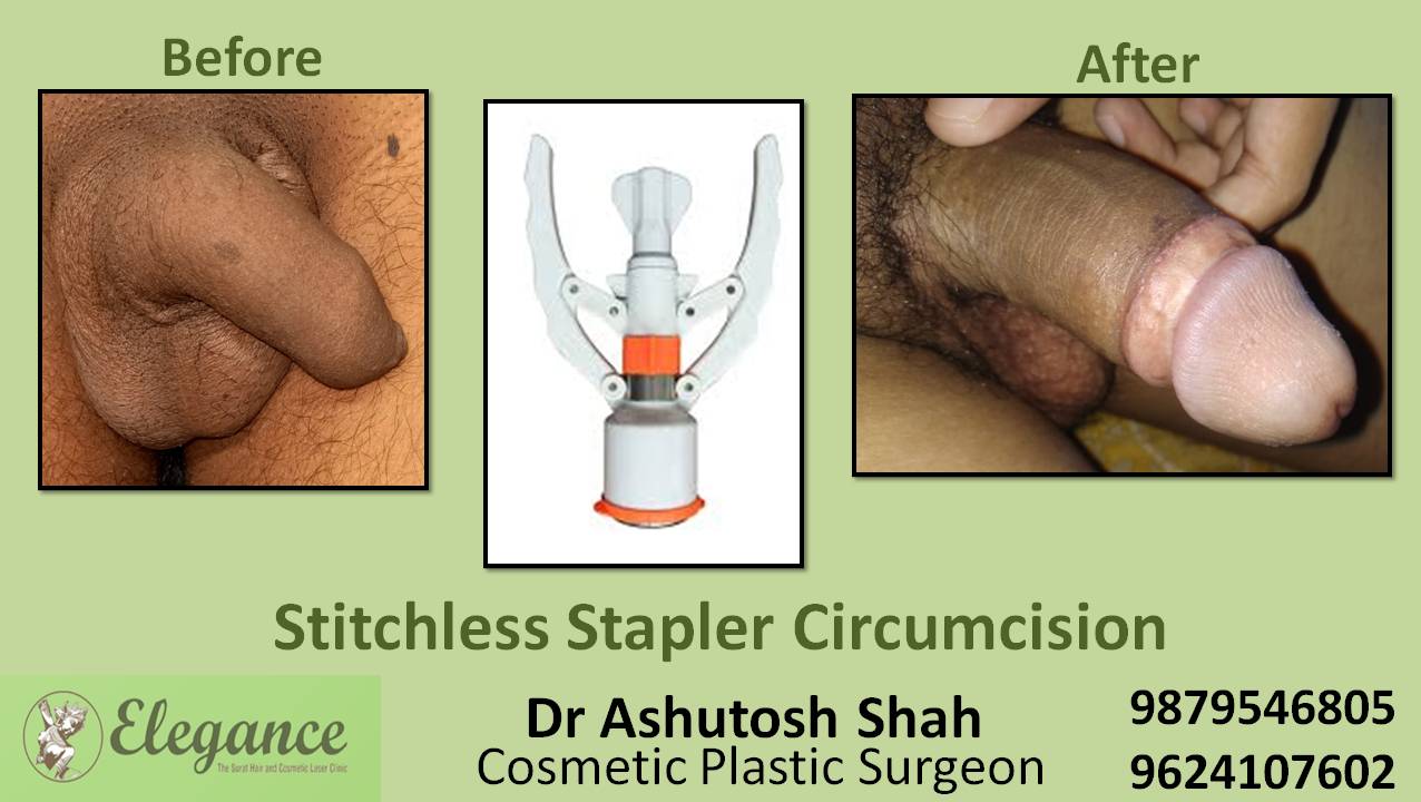 Stapler Circumcision Treatment, Kosamba, Gujarat, India.