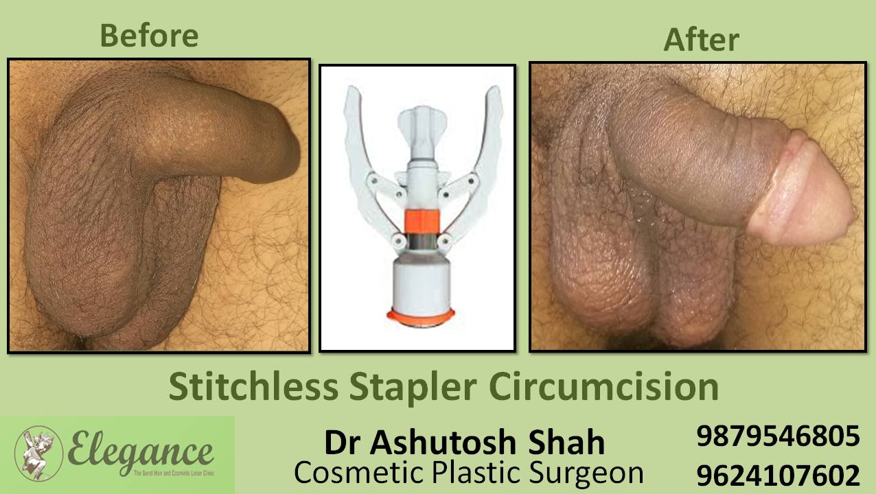 Stapler Circumcision Treatment, Mangrol, Gujarat, India.