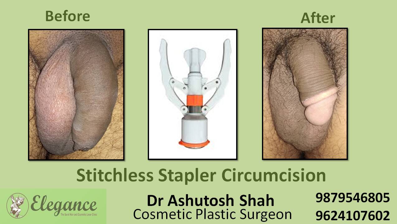 Stapler Circumcision Treatment, Navsari, Gujarat, India.