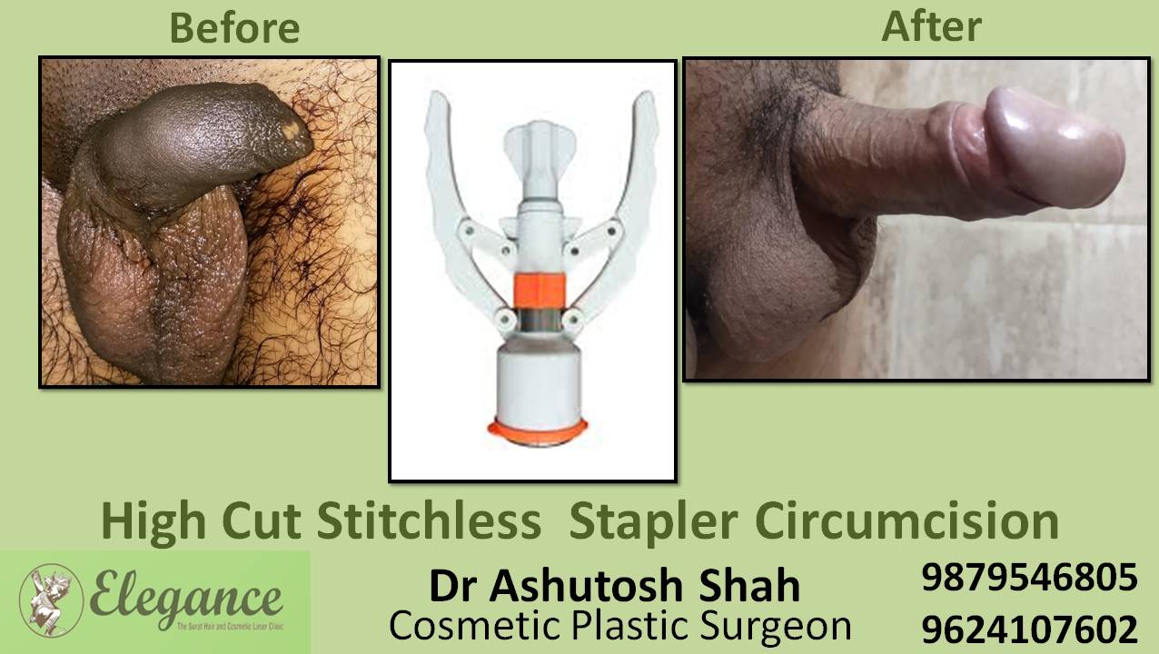 Stapler Circumcision Treatment, Navsari, Gujarat.