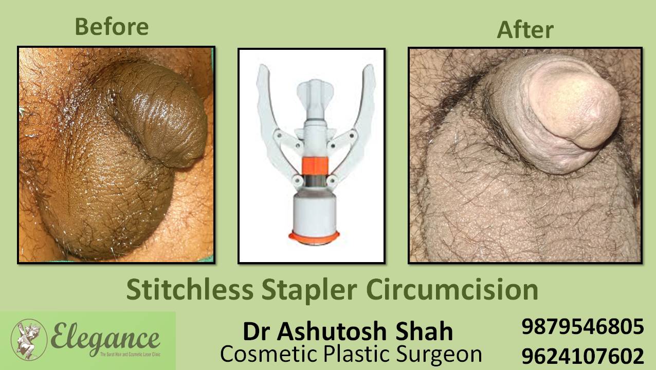 Stapler Circumcision Treatment, Selvasa, Gujarat, India.
