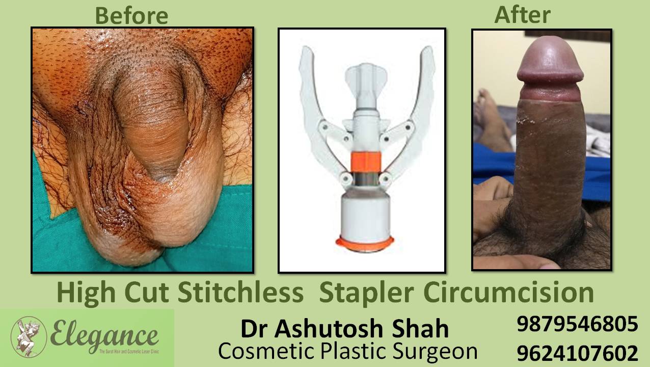 Stapler Circumcision Treatment, Vadodara, Gujarat.