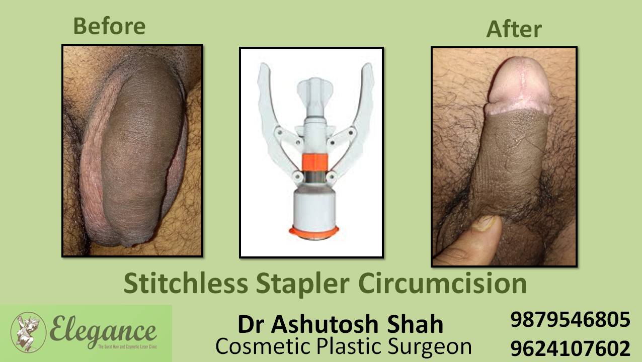 Stapler Circumcision Treatment, Valsad, Gujarat, India.