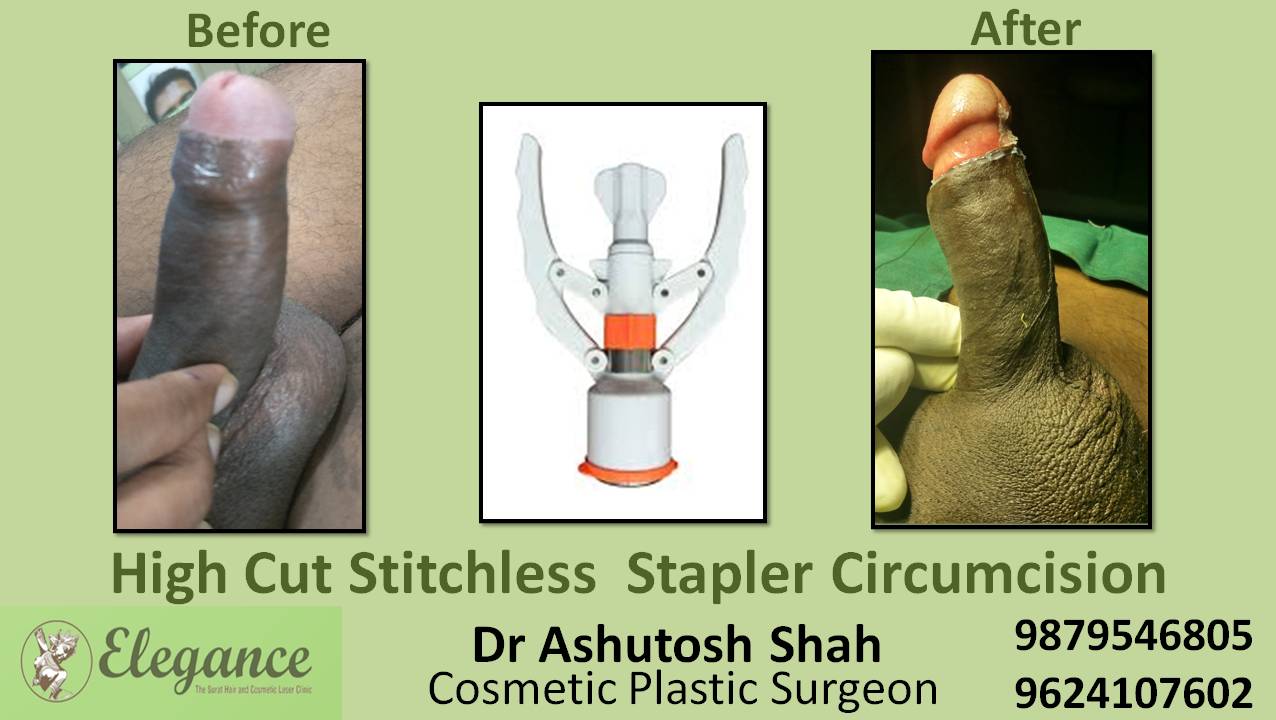 Stapler Circumcision Treatment, Valsad, Gujarat.