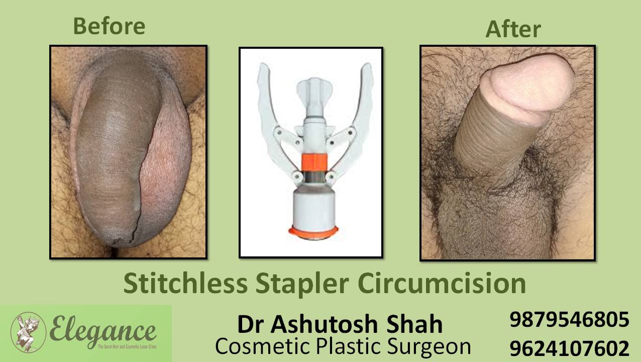 Stapler Circumcision Treatment, Vapi, Gujarat, India.