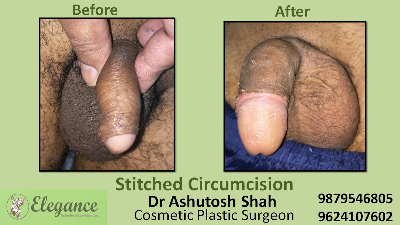 Stich Circumcision Surgery, Surat, Gujarat, India