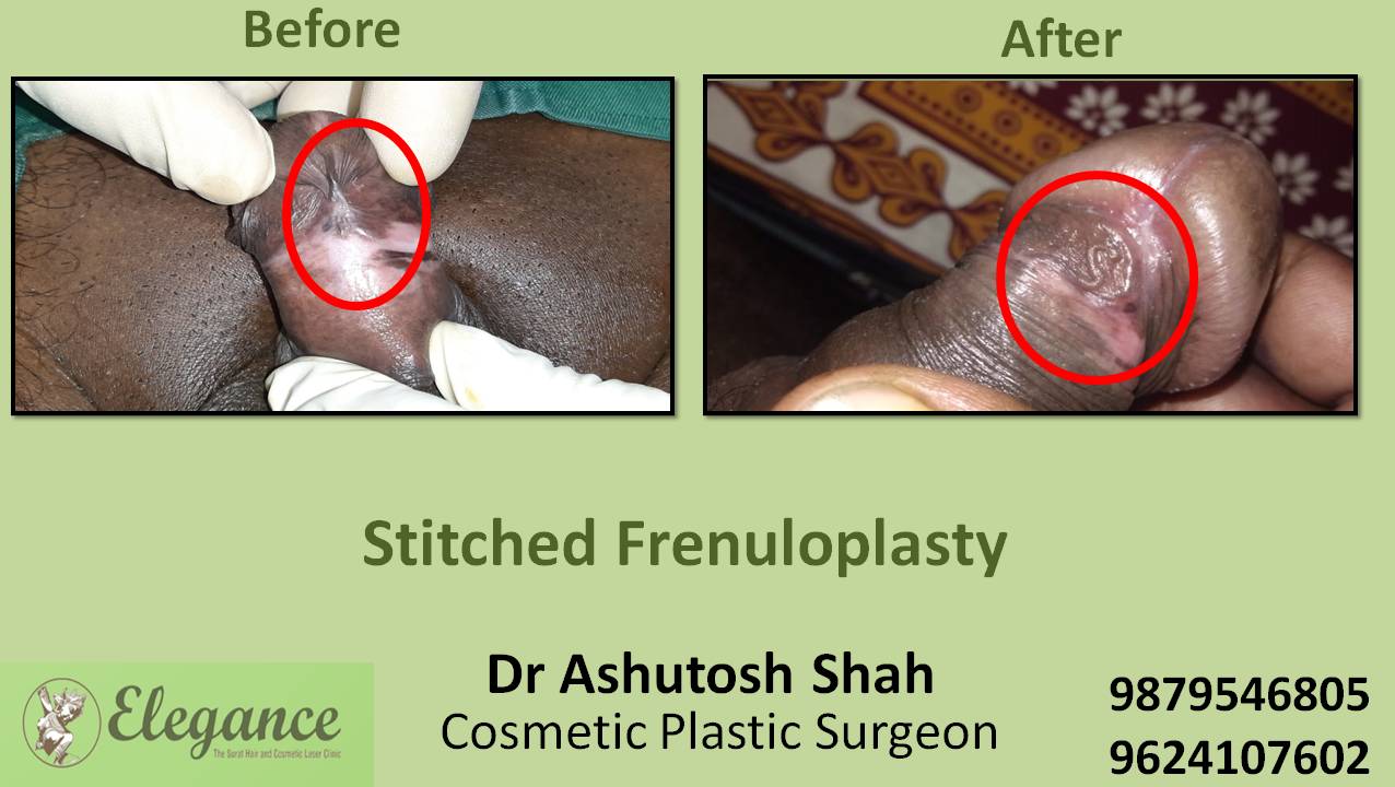 Stitchless Frenuloplasty