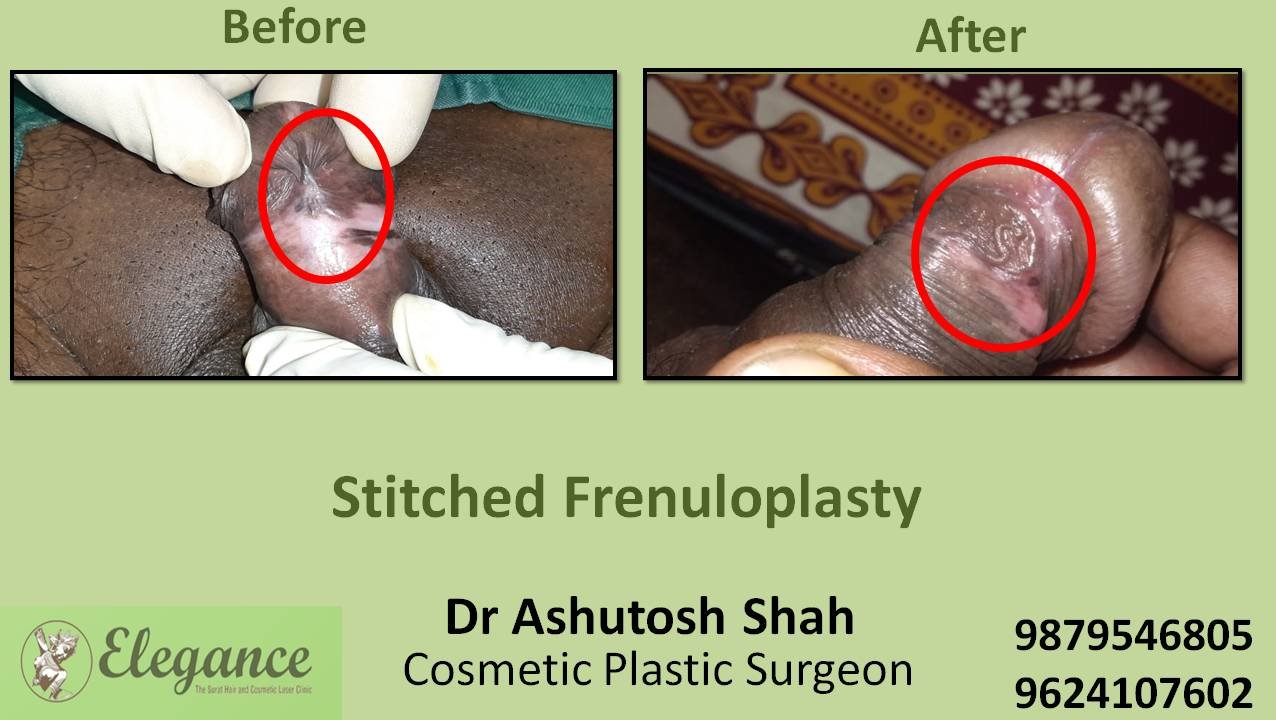 Stich Frenuloplasty, Surat, Gujarat, India