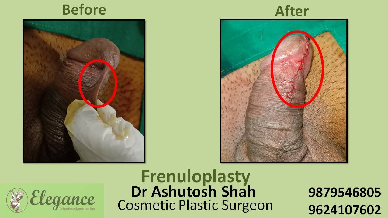 Stich Frenuloplasty, Vadodara, Gujarat, India