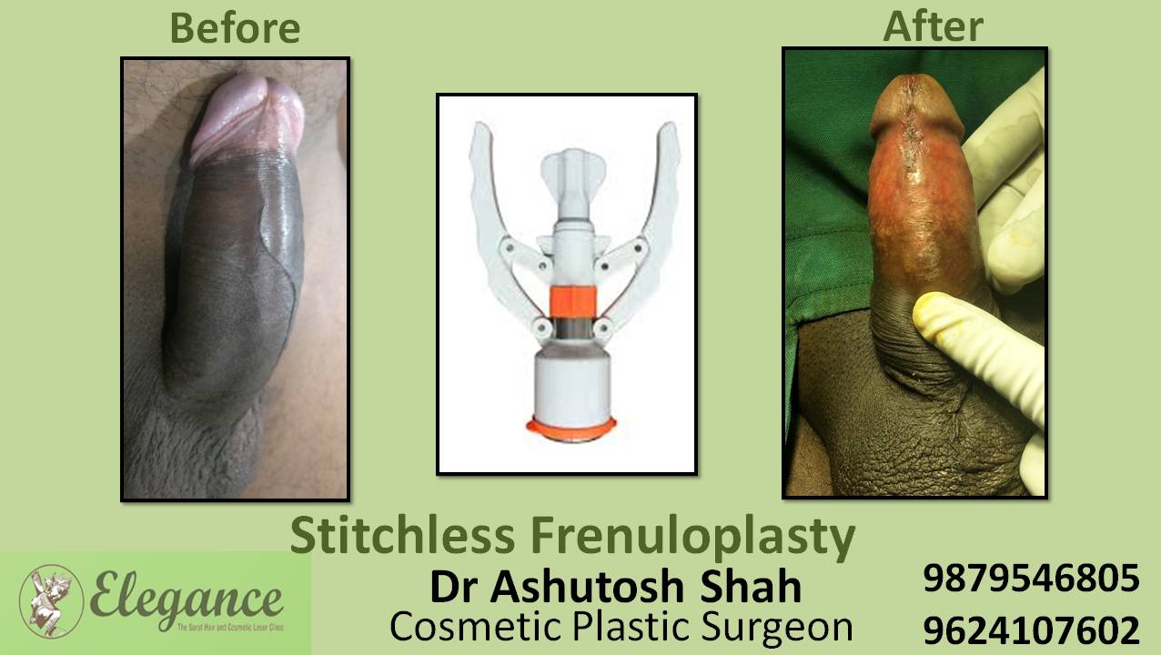 Stichless Frenuloplasty Surgery, Bardoli, Gujarat, India