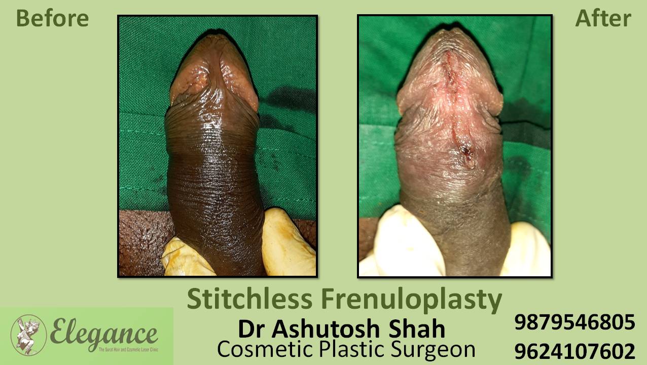 Stichless Frenuloplasty Surgery, Daman, Gujarat, India