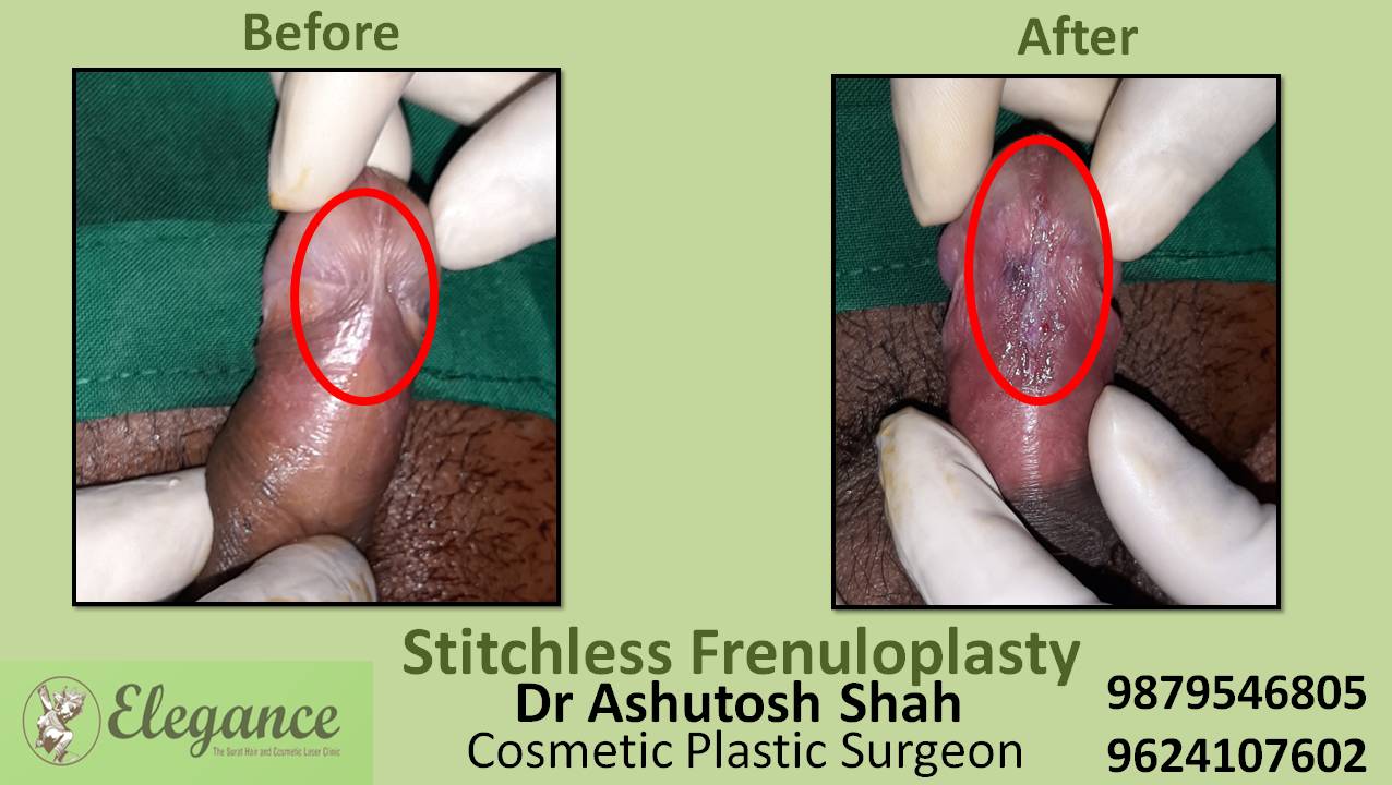 Stichless Frenuloplasty Surgery, Valsad, Gujarat, India