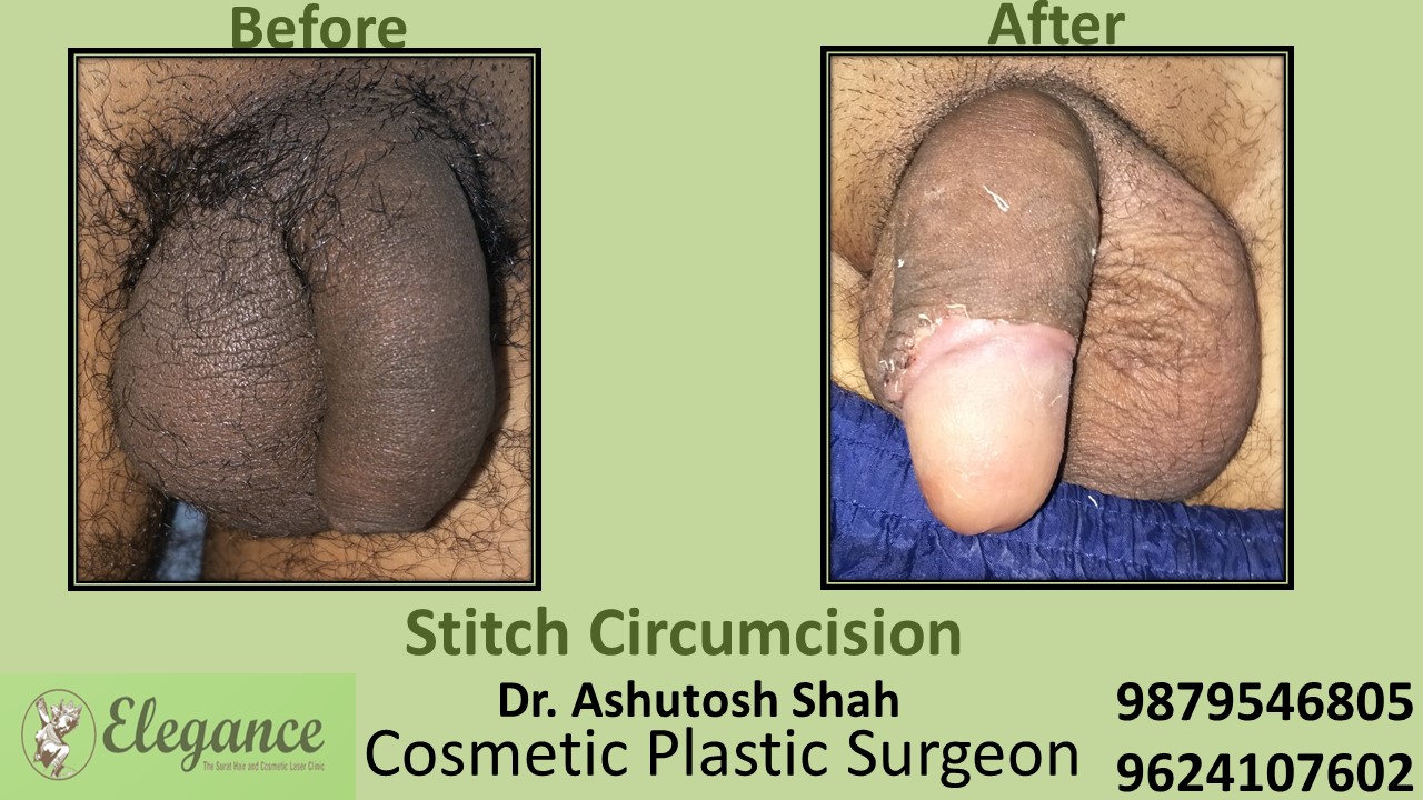 Stitch Circumcision in Surat