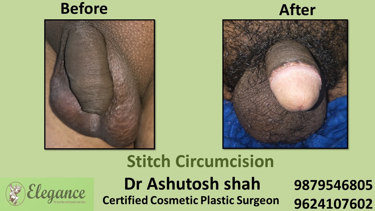 Stitchless Frenuloplasty in Bharuch