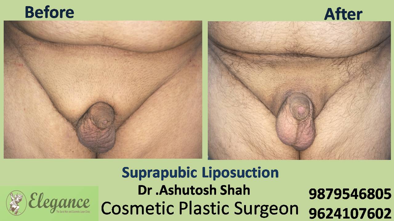 Suprapubic Liposuction Surgery in Surat, Gujarat (India)