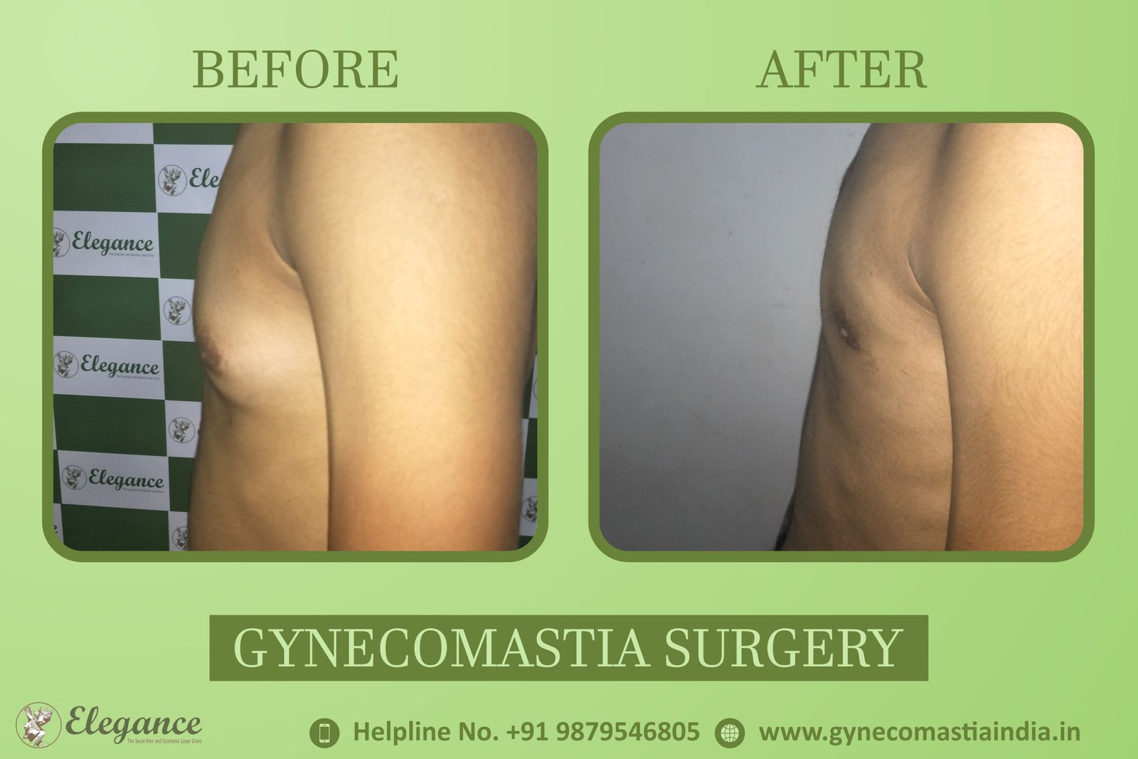 Surat, Gujarat, india Gynecomastia Clinic