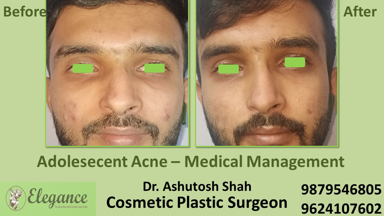 Teenage Acne Treatment In Surat, Bharuch, Vapi.